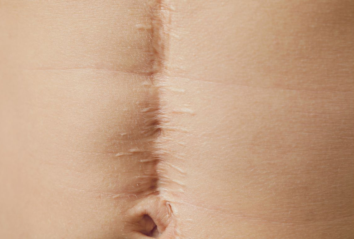 Behandlung Bauchnarbe